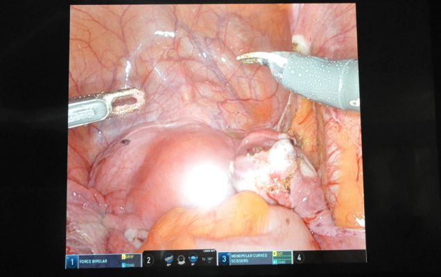 Robotic Workshop – Mastering in Deep Endometriosis - relacja z wydarzenia