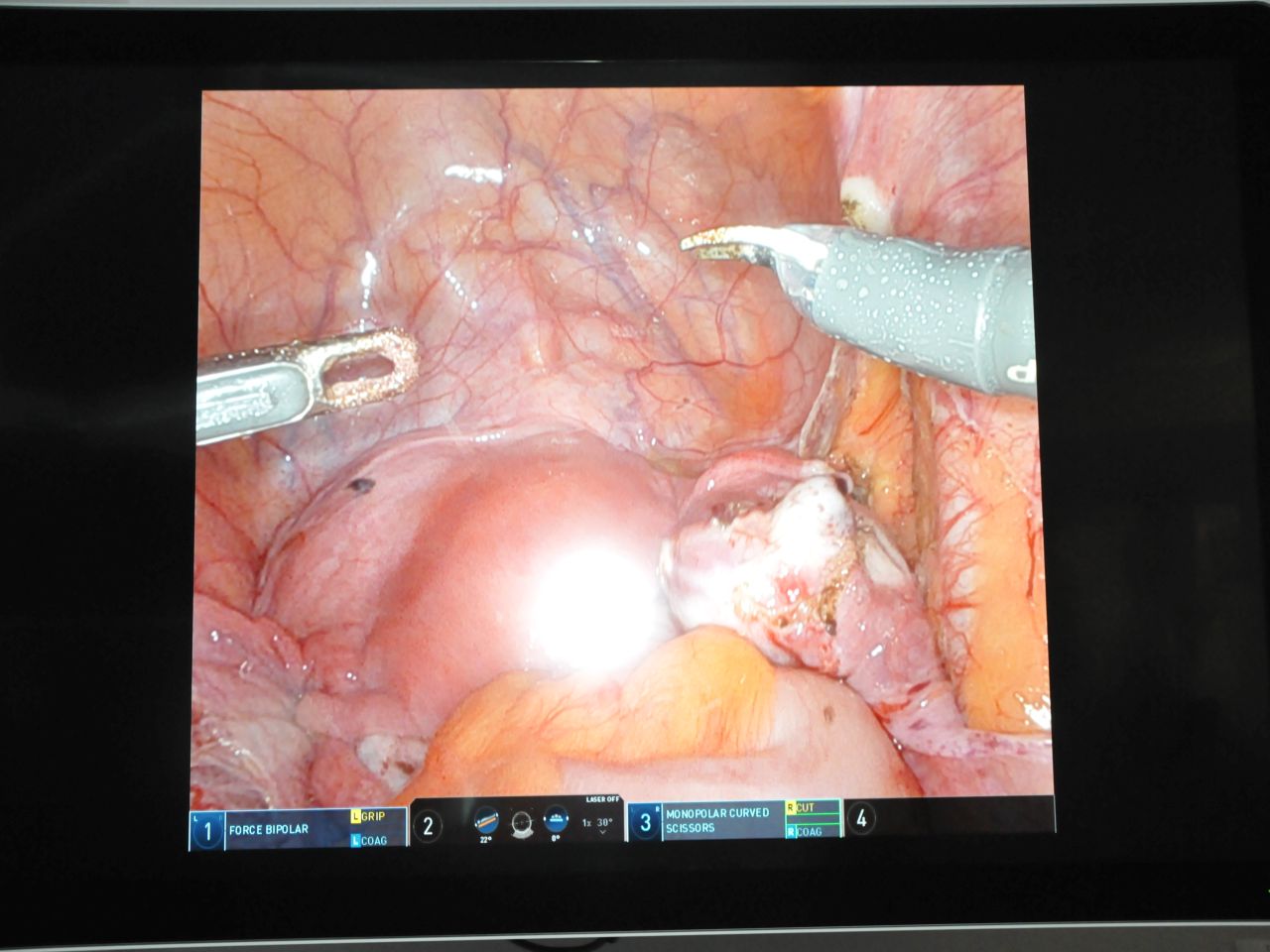 Robotic Workshop – Mastering in Deep Endometriosis - relacja z wydarzenia